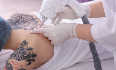 rimozione tatuaggi