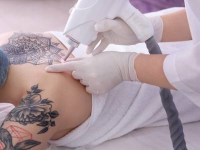 Come rimuovere un tatuaggio: consigli, tecniche e costi dell’operazione