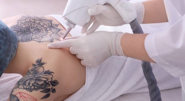 Come rimuovere un tatuaggio: consigli, tecniche e costi dell&#8217;operazione