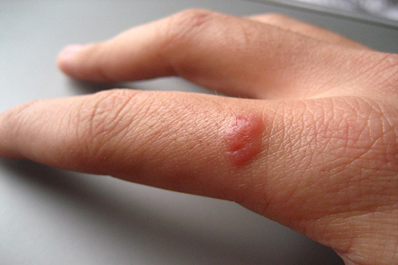 Verruca sulla mano