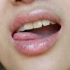 Bolle sulla lingua: cause e rimedi per sbarazzarsene