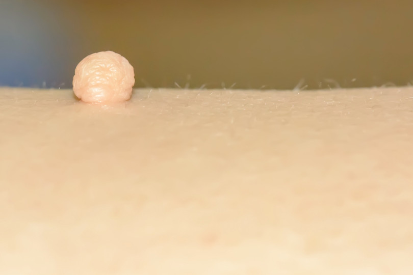Fibromi penduli