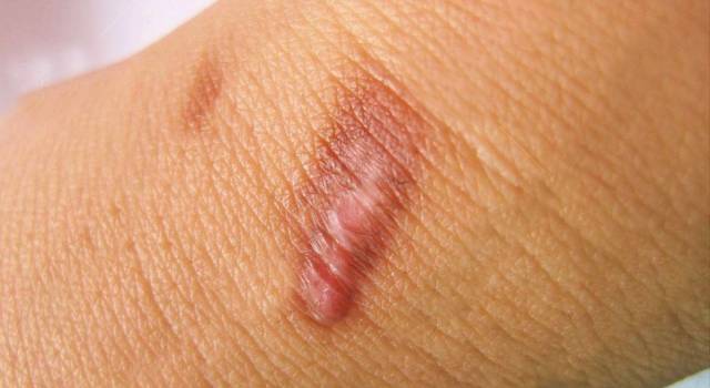 Inestetismi e cicatrici sulla pelle: scegliere una crema efficace