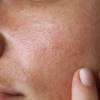 Macchie sul viso: i rimedi naturali per eliminarle