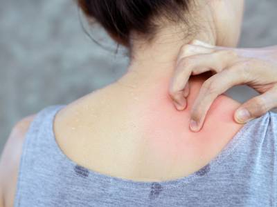 Dermatite da sudore e…infiammazioni? Le cause e i rimedi della nonna per combatterle