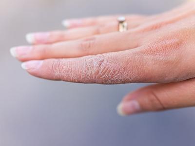 Dermatite alle mani: cos’è, quali sono le cause e come si cura