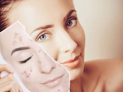 Peeling acne: a cosa serve e come funziona