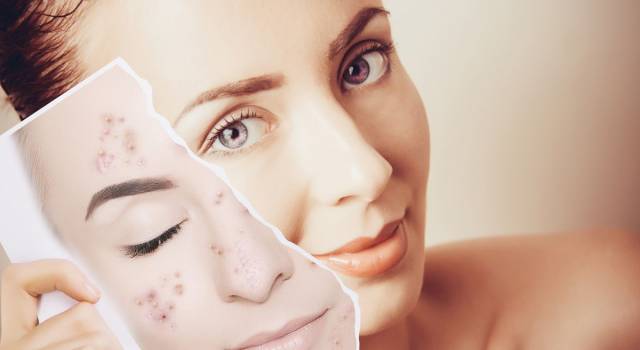 Peeling acne: a cosa serve e come funziona