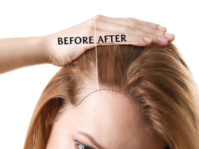 Diradamento capelli: perché avviene e cosa fare per evitarlo