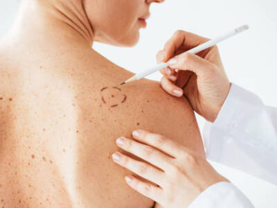 Melanoma: cos’è, come si forma e cosa fare per riconoscerlo