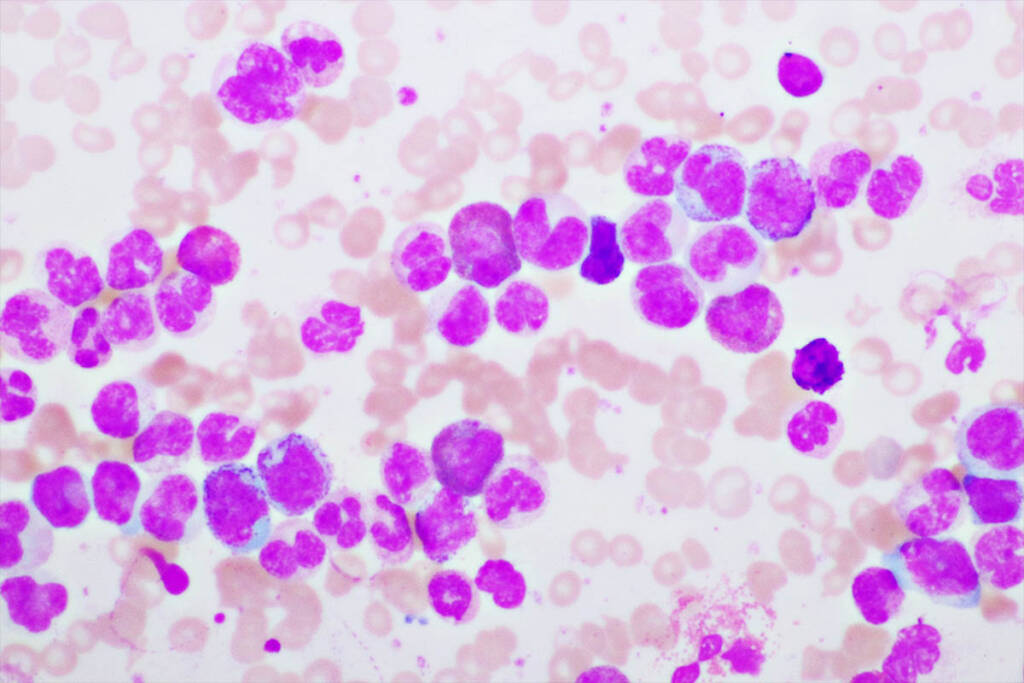 leucemia