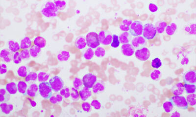 leucemia