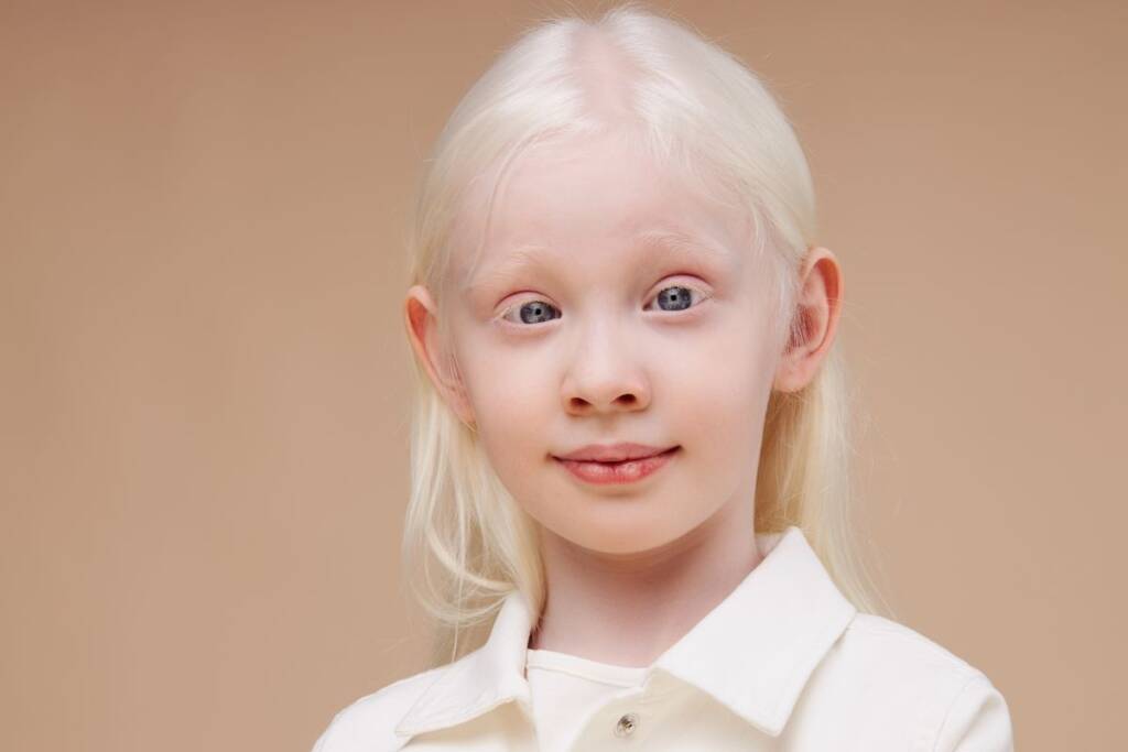 bambina albina