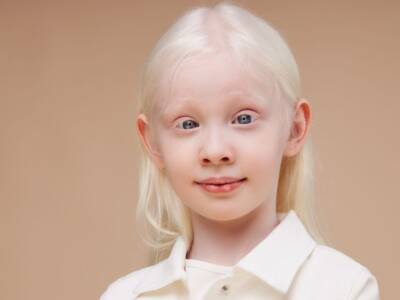 Albinismo: cos’è e cosa c’è da sapere a riguardo