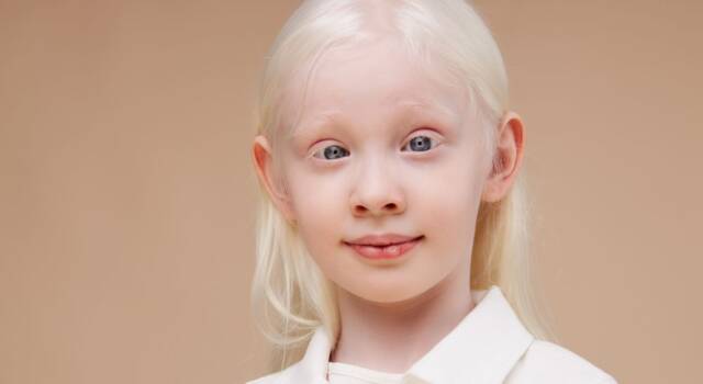 Albinismo: cos&#8217;è e cosa c&#8217;è da sapere a riguardo