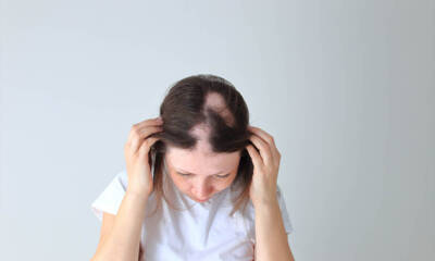 alopecia