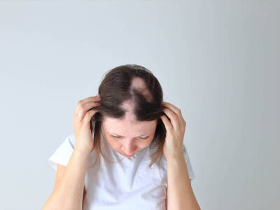 Alopecia: cos’è, cause, sintomi e come si cura