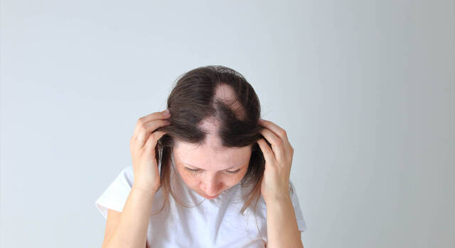 Alopecia: cos&#8217;è, cause, sintomi e come si cura