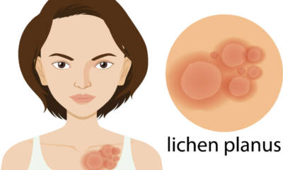 lichen planus