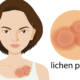 lichen planus