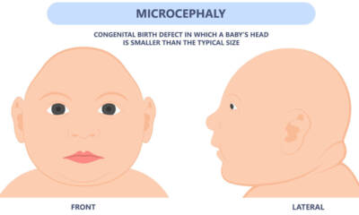 microcefalia