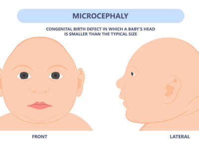 Microcefalia nel bambino, cos’è e cosa comporta