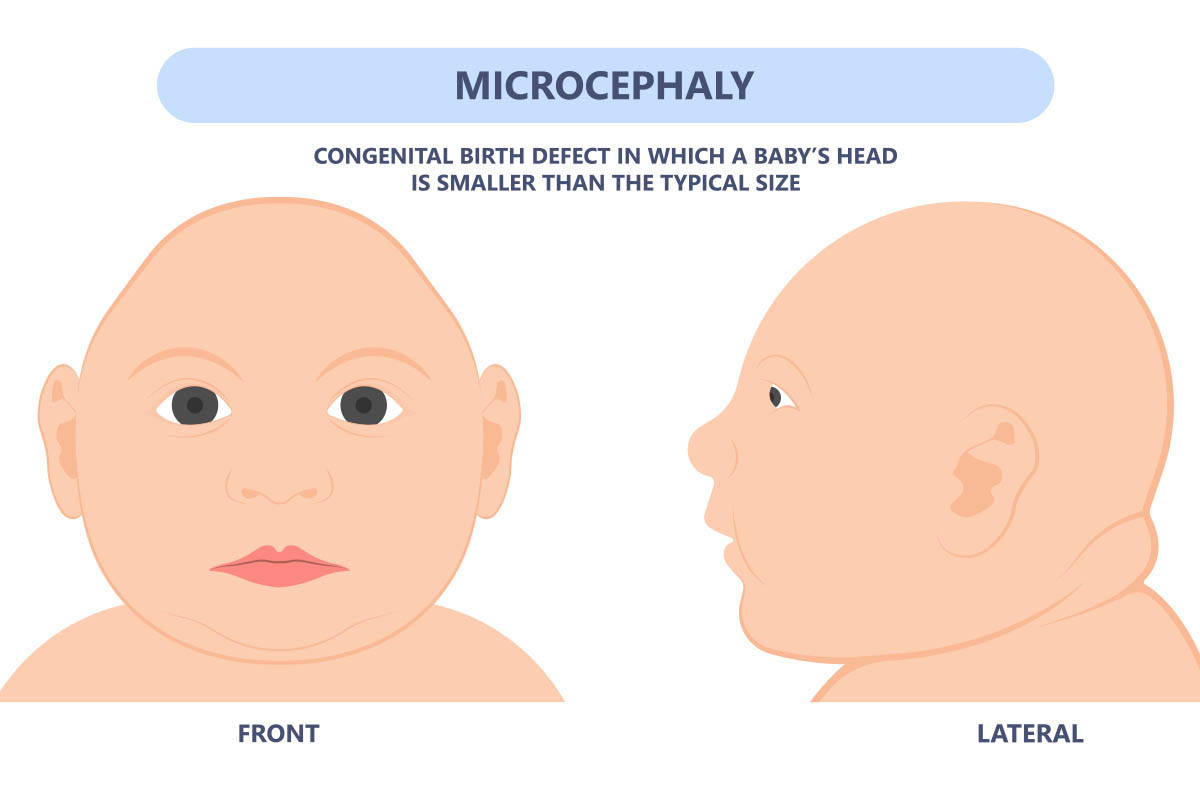 microcephaly