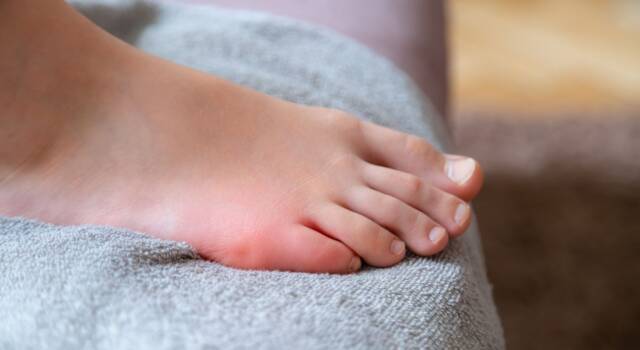 Frattura al mignolo del piede: sintomi e possibili cure