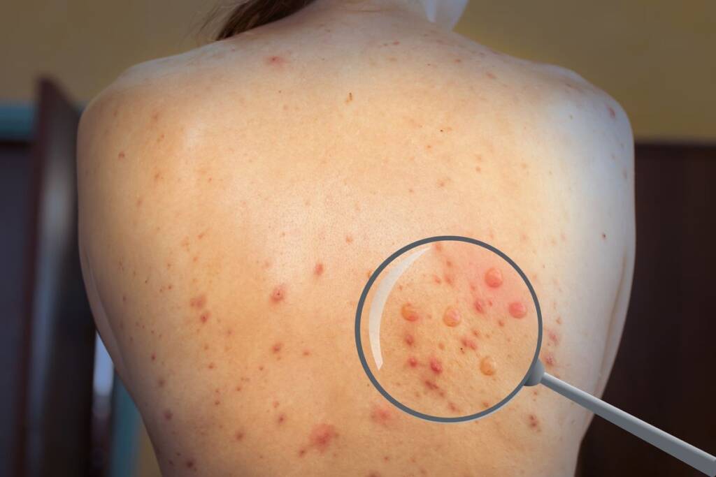 papular urticaria