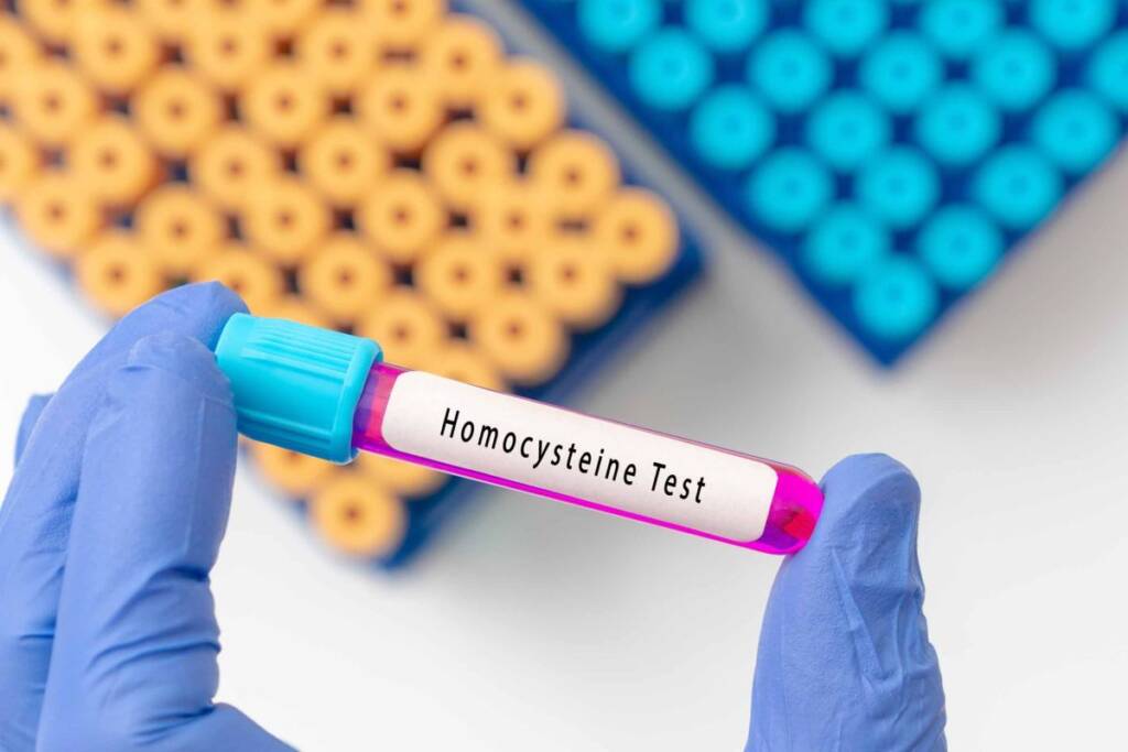 homocysteine ​​test