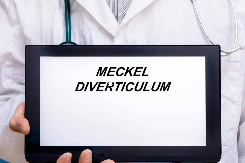 diverticolo di meckel