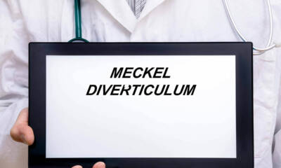 diverticolo di meckel