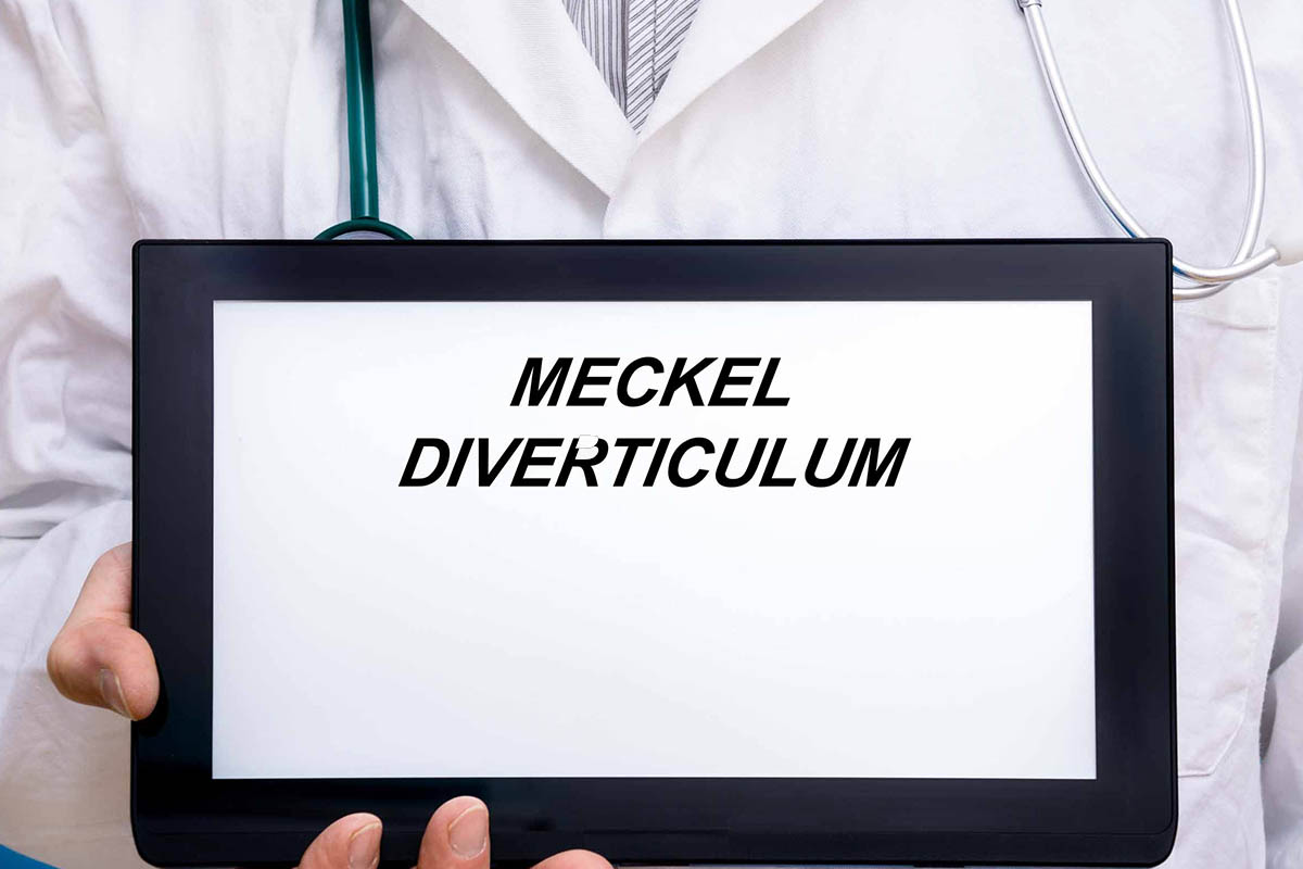diverticulum of meckel