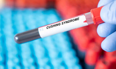 sindrome di cushing