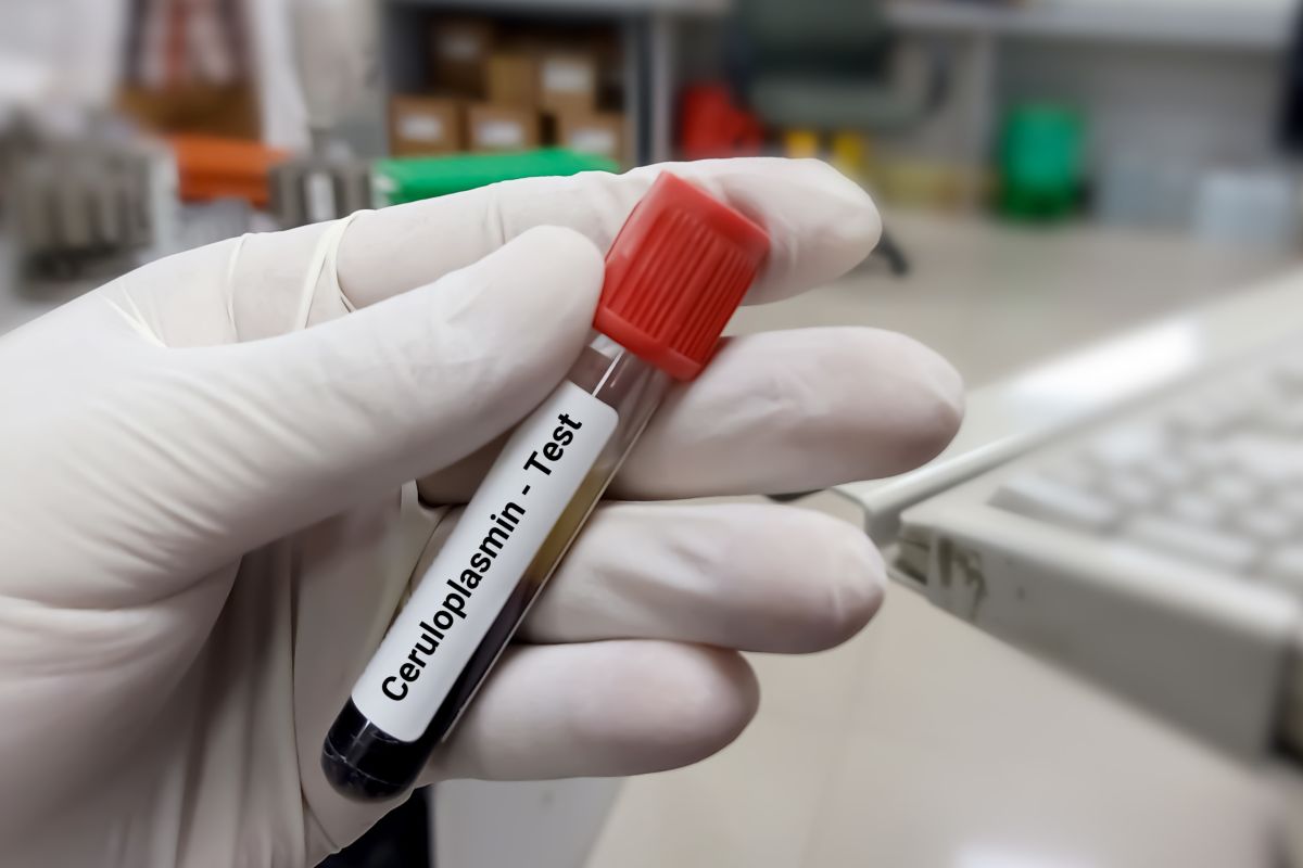 blood sample ceruloplasmin test
