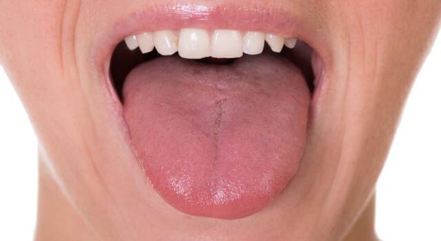 Tagli sulla lingua: come combattere in modo efficace la lingua fissurata?