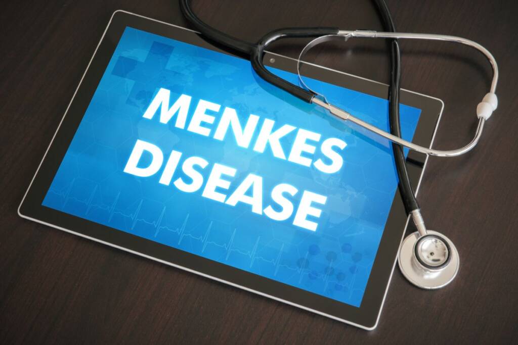 malattia di menkes