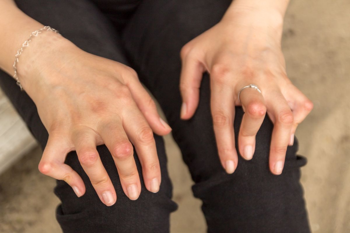rheumatoid arthrosis woman hands