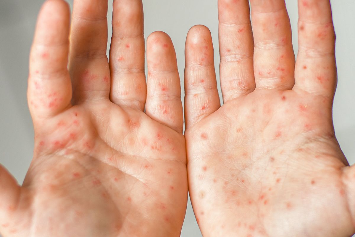 dots hands disease