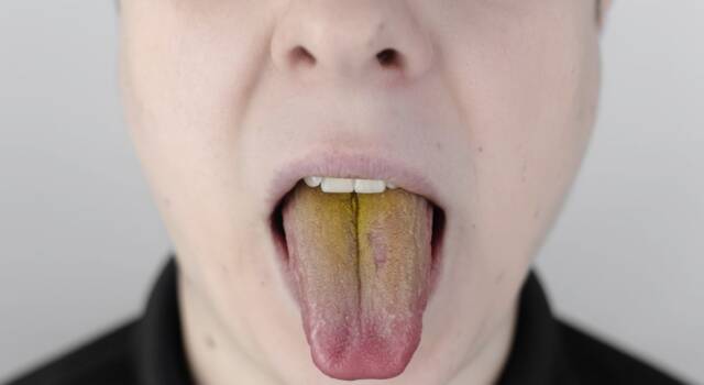 Lingua gialla: una corretta igiene orale è fondamentale