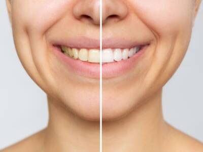 Denti gialli: rimedi naturali per tornare ad avere un sorriso smagliante