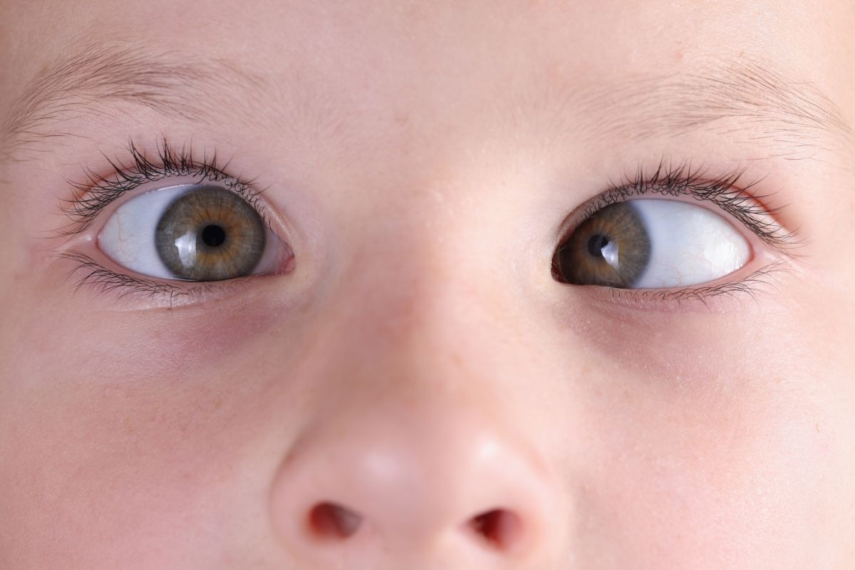 Eyes with strabismus
