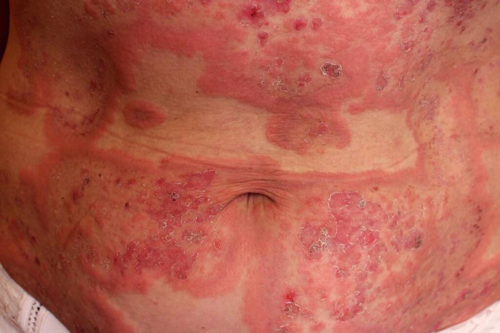 skin belly rash