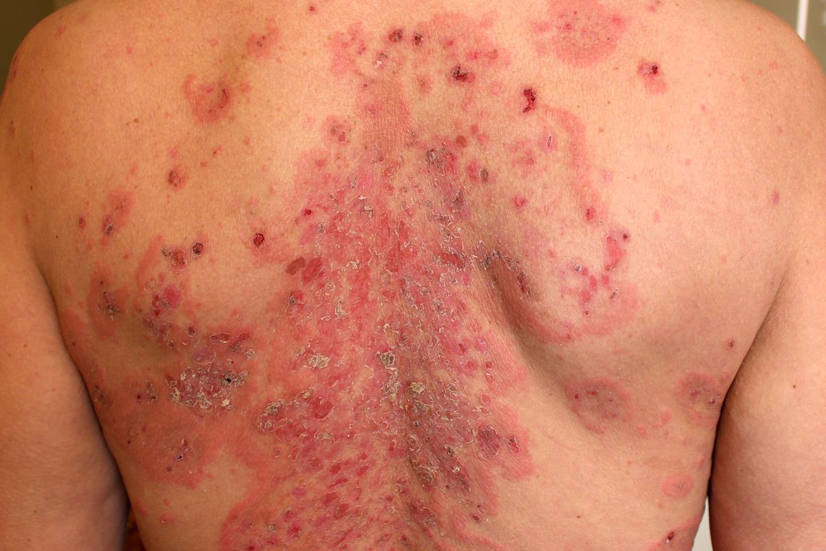 psoriasis back rash