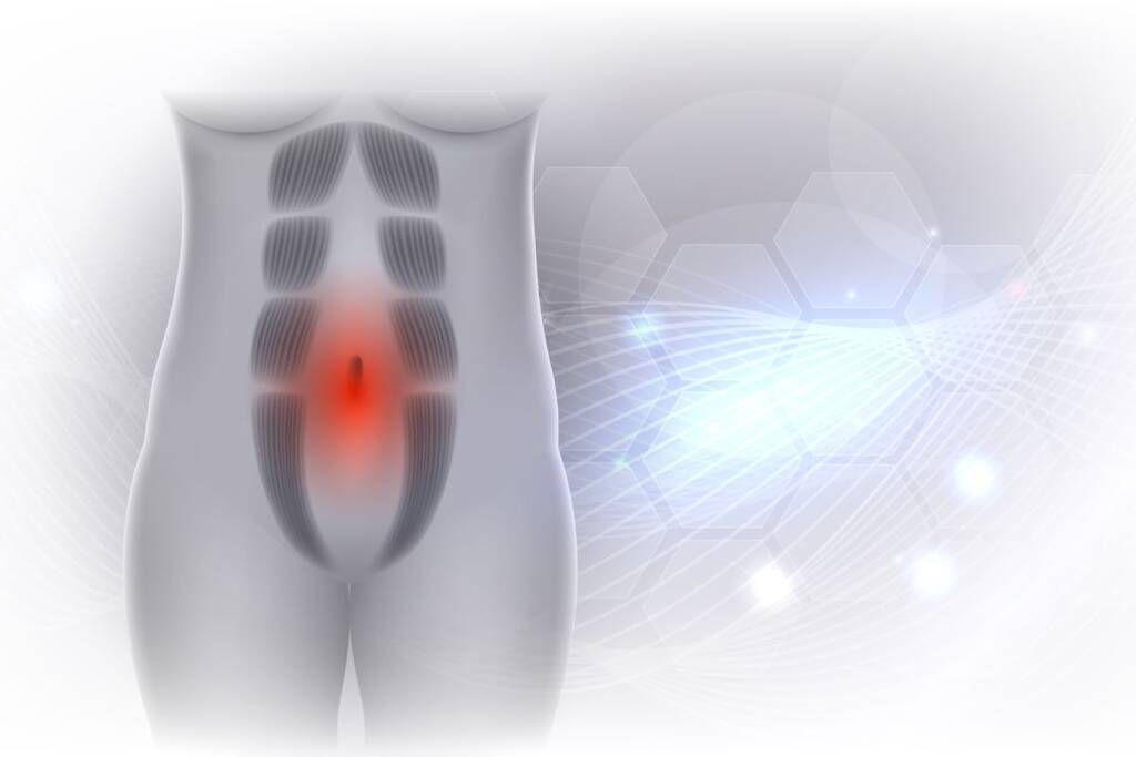 abdominal diastasis