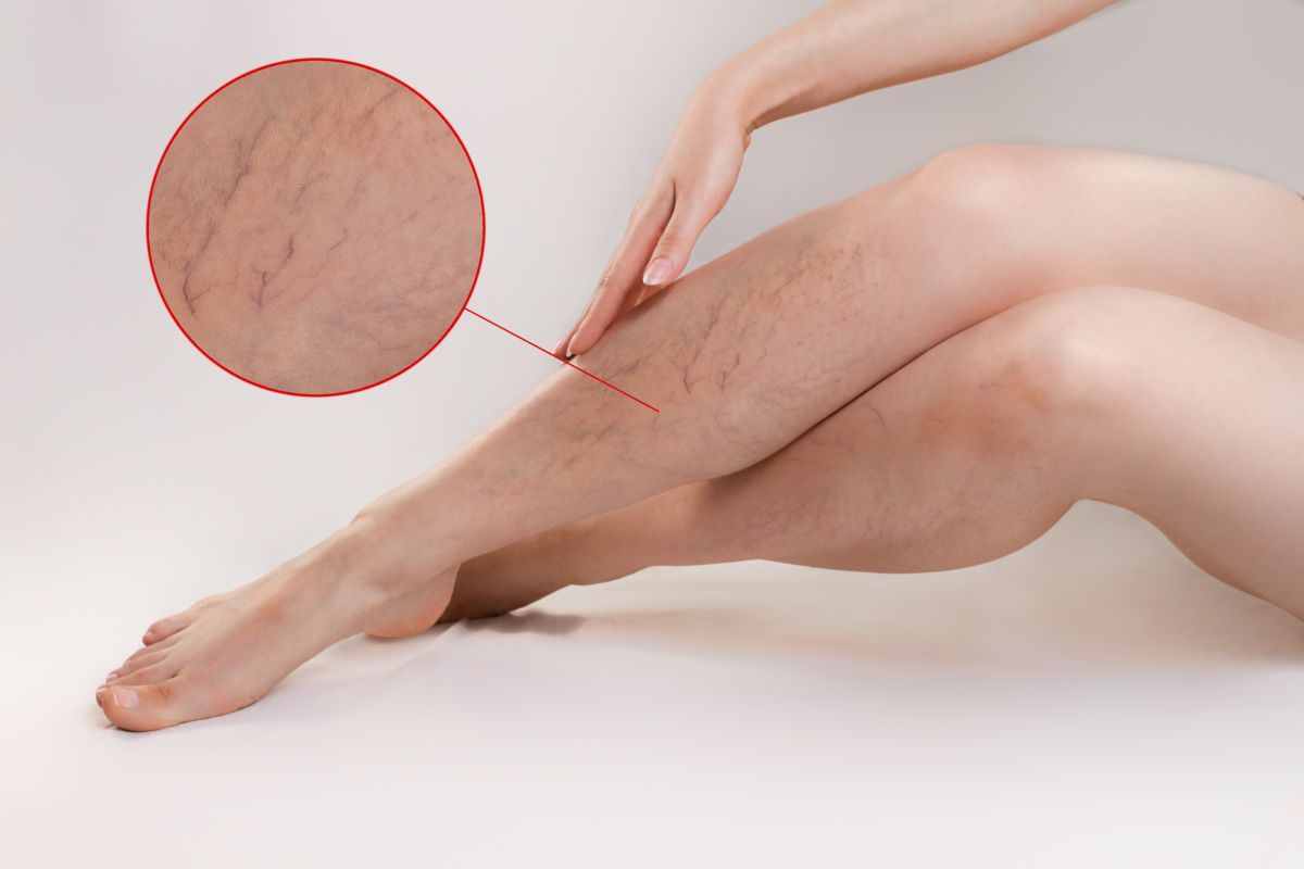 varicose veins