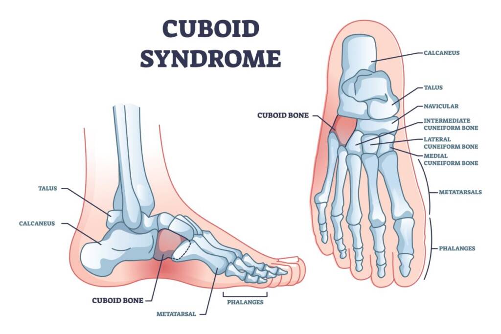 sindrome del cuboide